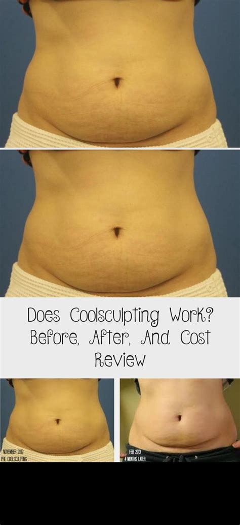 I used a heat blower after i poured to get most bubbles out. Does Coolsculpting Work? Before, After, And Cost Review | Easy