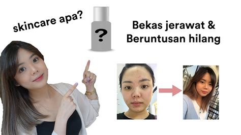 Laser crt (collagen rejuvenation theraphy), memperbaiki scar akibat jerawat dan menghilangkan kulit kusam. CARA MENGHILANGKAN BEKAS JERAWAT MERAH & BERUNTUSAN - YouTube