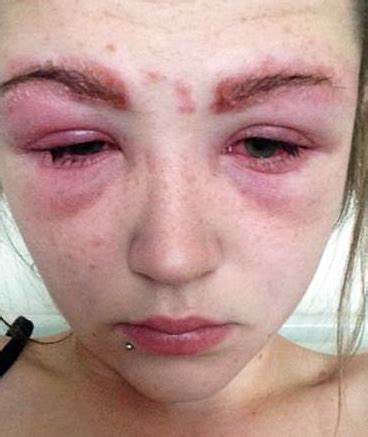 Les pignons et les pistaches ont une presque la moitié des petits enfants allergiques aux noix souffrent d'une 2ème allergie aux cacahuètes, ce qui est beaucoup moins fréquent chez. Allergie aux acariens dans la poussière domestique: ses ...