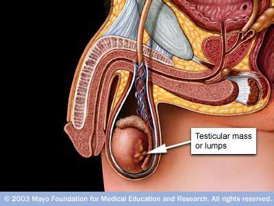 His cancer had spread to his lungs, stomach and brain. HEALTH BULLETIN .CO: Testicular cancer