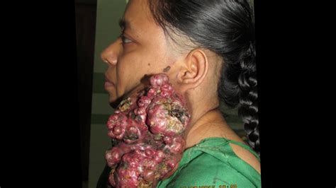 You might feel like food is stuck in your throat. pleomorphic adenoma | Neck surgery | Biggest neck surgery ...