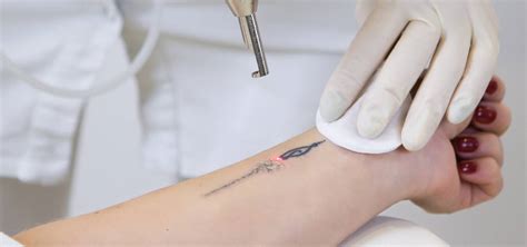 Maybe you would like to learn more about one of these? Laser Tattoo Removal Services | Get Rid of Unwanted Tattoos