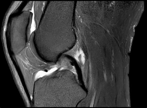 Das hilft dem arzt zum beispiel dabei, feine risse im meniskus sowie durchblutungsstörungen zu erkennen. MRT - Radiologie