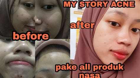 Jerawat merupakan merupakan penyakit yang mempengaruhi kelenjar minyak pada kulit. MY STORY ACNE - CARA AMPUH HILANGKAN BEKAS JERAWAT PAKAI ...