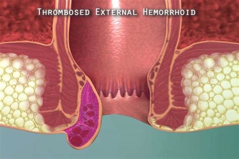 An inside story of a thrombosed pile. Facts About External Thrombosed Hemorrhoids