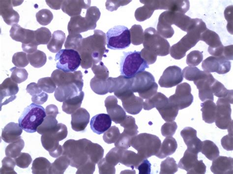 Enter hue in degrees (°), saturation and value (0.100%) and press the convert button Acute hepatitis due to infectious mononucleosis | BMJ Case ...