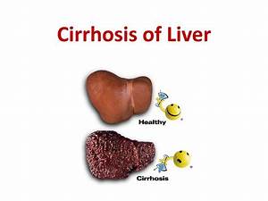PPT - Cirrhosis of Liver PowerPoint Presentation, free download - ID:9439743 Cirrhosis  