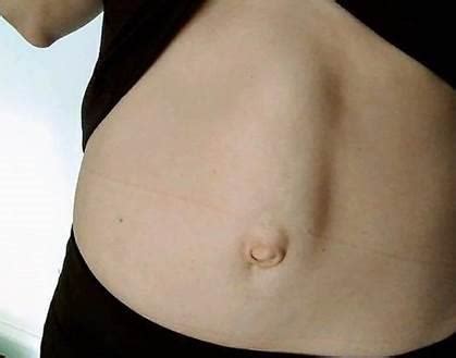 Causes of hernia during pregnancy hernias are the result of a weakness in the wall of a muscle or a muscle that never fully grows together. ARE UMBILICAL HERNIAS RELATED TO DIASTASIS RECTI?