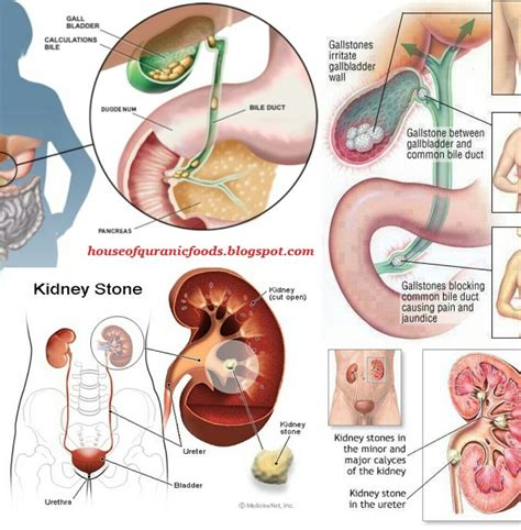 Hilangkan terus penyakit gastrik dalam 1 bulan. Perubatan Islam Secara Jarak Jauh - Sawahan c