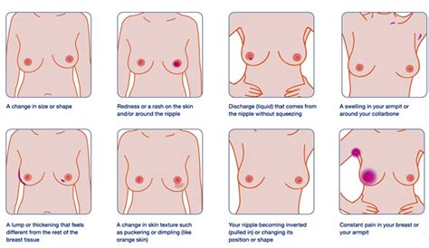Untuk mengetahui tanda tanda kanker payudara stadium 1 ada didalam diri anda atau tidak, baiknya anda lakukan pemeriksaan sadari (periksa payudara sendiri). Penyakit Kronik | Kanser Payudara Pembunuh Nombor 1 Wanita ...