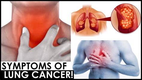 Persistent weight loss has also been linked to lung cancer, while some people find the ends of their fingers appear fatter than normal. 5 SURE SIGNS AND SYMPTOMS OF LUNG CANCER 😍 LUNG CANCER ...