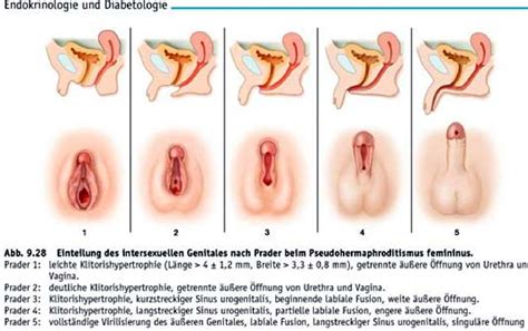 417 pseudohermaphroditismus (griech.), der scheinbare hermaphroditismus beim menschen (s. Intersex-Genitalverstümmler Markus Bettendorf (Uni ...