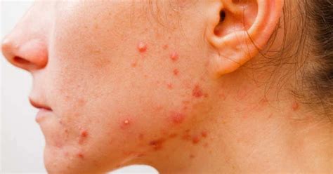 Maybe you would like to learn more about one of these? How to cure acne ? - HEALTHY LIFE