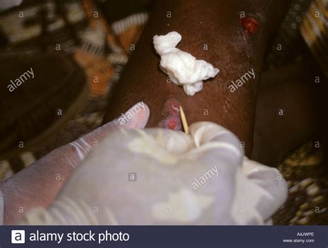 Der medinawurm oder guineawurm ist ein parasitisch vorkommender fadenwurm und der erreger der dracontiasis. Guinea Worm Emerging Niger Stockfotos und -bilder Kaufen ...