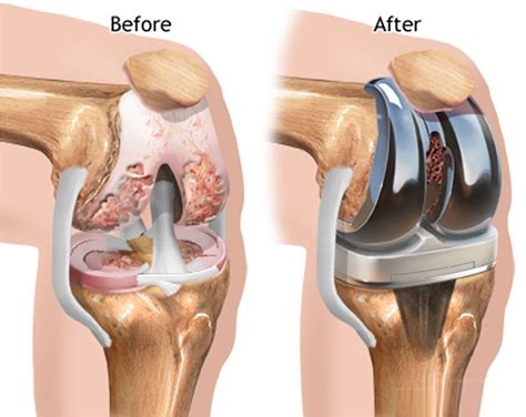 In arthroscopic surgery the surgeon looks 360 degrees around the entire knee. Knee Replacement - Surgery, Recovery Time, Complications