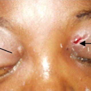 In these animals modified by heredity, the two eyes generally protruded, although in the parents usually only one showed exophthalmia, the lesion having been. (PDF) Bilateral intraorbital abscesses with intracranial ...