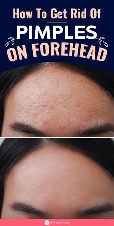 Desert cactus don't tend to survive as ground cover in the extremes of absolutely no water or overwatering. How To Get Rid Of Pimples On Forehead in 2020 | Pimples on ...