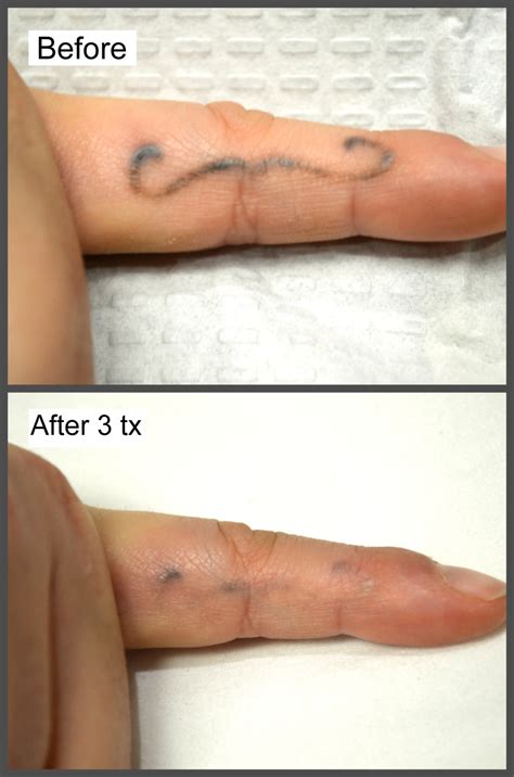 Let's assume that you have a tattoo of 6cm x 4cm on your body. Cost of Tattoo Removal | Millefiori Medical Skin Rejuvenation