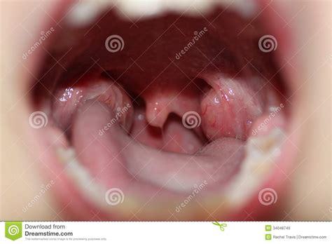 Was ist der unterschied zwischen viraler und bakterieller mandelentzündung? Amandelontsteking stock afbeelding. Afbeelding bestaande ...