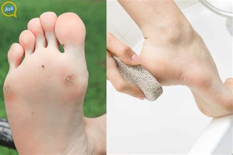 To relieve corns that develop between the toes, separate them using organic cotton or lamb's wool. What causes Corn between Toes? How to remove it?