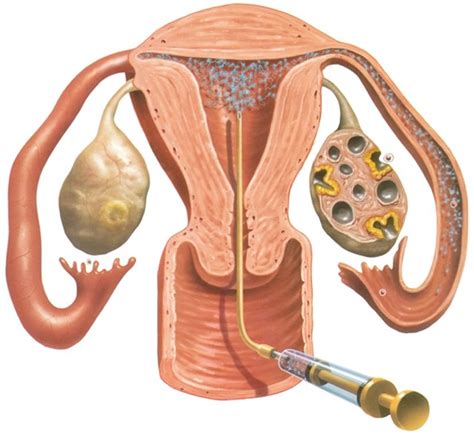 Kit d'inmasturbation artificiel pour lapin, équipement automatique de ferme. Insemination artificelle Tunisie : Prix fécondation intra ...