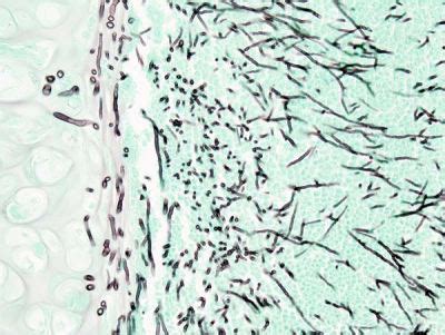 Léčba cystické fibrózy neexistuje, ale léčba může zmírnit symptomy a snížit komplikace. Cystická fibróza: Aspergilóza | Slané deti