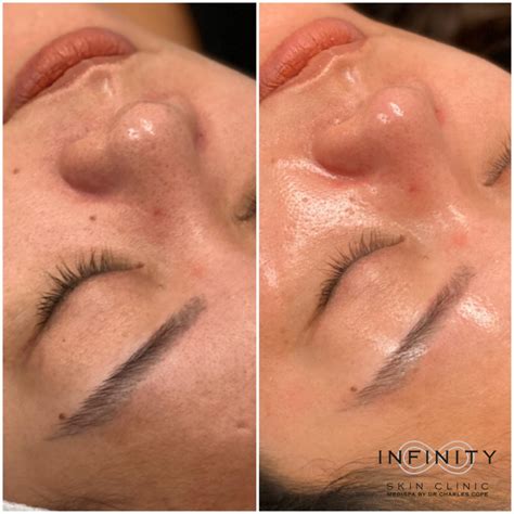 HydraFacial Before and After Images | Infinity Skin Clinic