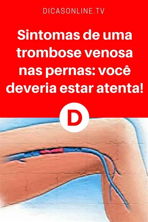 Trombose kan ontstaan in slagaderen en aderen. Trombose venosa | Sintomas de uma trombose venosa nas pernas: você deveria estar atenta! | Os ...