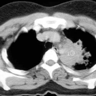 Lung cancer is the leading cause of cancer death worldwide, with approx. (PDF) Tuberculosis Can Mimic Lung Cancer: A Case Series