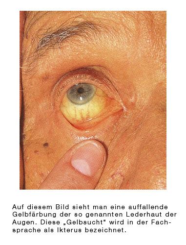 Jeder zehnte mensch in europa hat mit gallensteinen zu kämpfen. Gallensteine, Gallensteine, Cholelithiasis - eesom ...