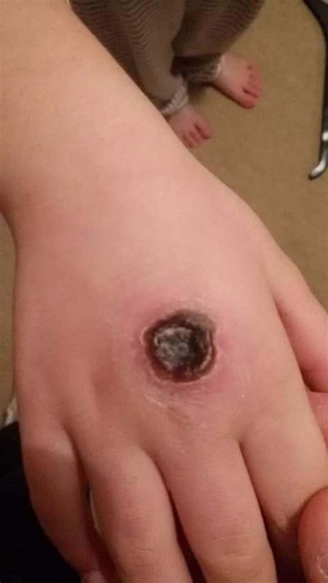 The initial brown recluse spider bite two weeks later! Girl, 5, left with oozing wound after venomous spider bite ...