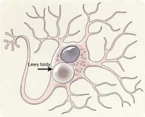 Lbd is a progressive brain disease that affects. Doctors Gates: Lewy body dementia when compared to ...