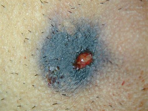 Some bullets may pass through the body and travel out, showing another wound called the exit wound. Loose contact gunshot wound with soot staining | Forensics ...