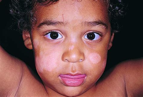 Based on studies, the skin disorder is often seen in children ages 6 to 12. Pityriasis Alba - National Pharmarcy