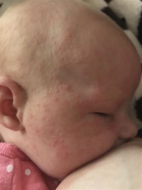 Aden: Baby Acne Breast Milk On Face