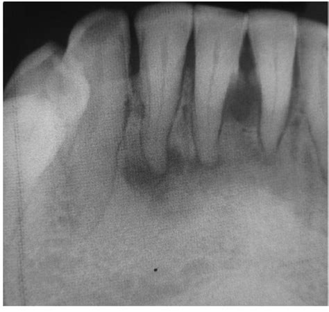 Radiographically it passes through the three phases(osteolytic stage, intermediate stage. FOCAL CEMENTO-OSSEOUS DYSPLASIA PDF