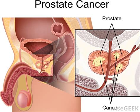 Well first of all let's say it: Stages of Prostate Cancer - Survival Rates. - what are the ...