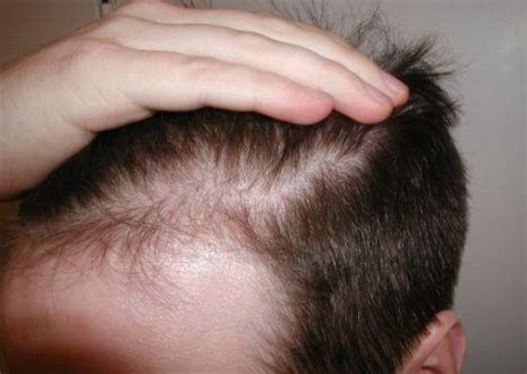 Scalp irritation is most often a sign of underlying inflammation of the scalp, which can lead to hair loss. CALVÍCIE: REVOLUCIONÁRIO TRATAMENTO É DESCOBERTO PARA CALVICE