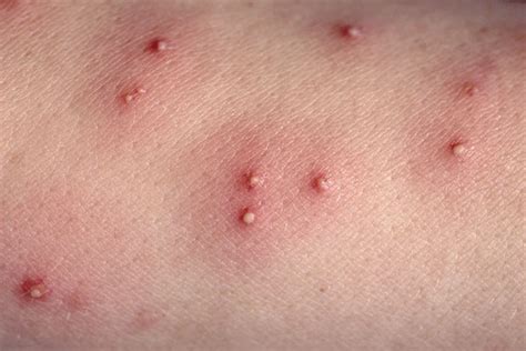 This morning i woke up with a terrible pain in my right leg. Jim's Termite & Pest Control -Controlling Fleas- 131 546