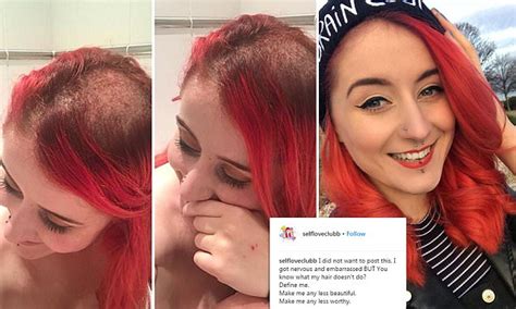 The infection with certain hpv weight loss, fatigue, loss of appetite; Blogger with cervical cancer shares photos of hair loss ...