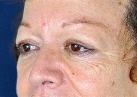 Maybe you would like to learn more about one of these? Eyelid Surgery Before and After Photos by Michael ...