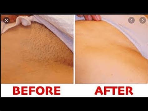 Plucking may be more gentle on the skin than waxing sam explains that plucking your pubic hairs can cause irritation and harm to the skin as this can also cause ingrown hairs and infection. WHAT YOU NEED TO KNOW ABOUT PUBIC HAIR REMOVAL - YouTube