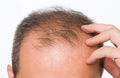 They come from a variety of sources and benefit the body in a variety of ways. Vitamin D Deficiency Hair Loss