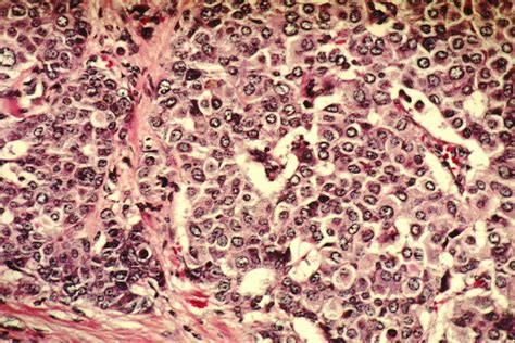 When breast cancer spreads to other parts of the body, it is said to have metastasized. File:Breast cancer cells (1).jpg - Wikimedia Commons