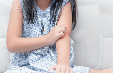 Untuk menangani penyakit ini, diperlukan pengobatan dari dokter. Kenali 12 Jenis Penyakit Kulit Pada Anak & Cara Mengatasinya