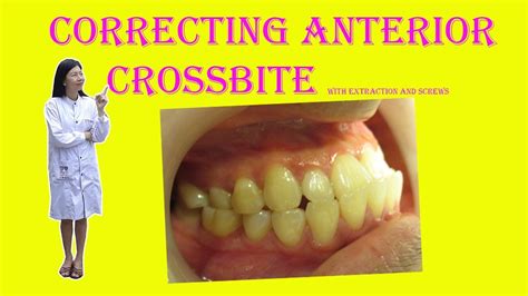 Crossbites in adults can also be treated through braces. Correcting Anterior Crossbite With Extraction And Screws ...