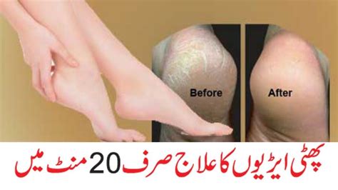 Soak your hands or feet.soaking your hands or feet in warm, soapy water softens corns and calluses. Pin on sana