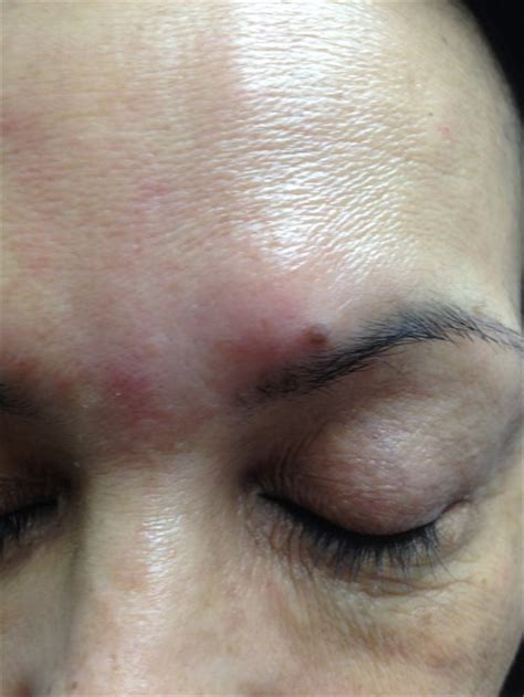 Does laser mole removal give you scars? Mole Removal - ExpressCare Guam Clinic | Doctors for ...