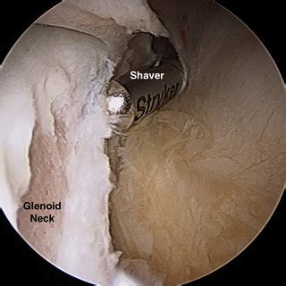 Labral tears is a cause of shoulder pain in some athletes. Arthroscopic photograph of the right shoulder ...