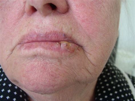 In the early stages, mouth cancer rarely causes any pain. Lip cancer: What it looks like and what to do